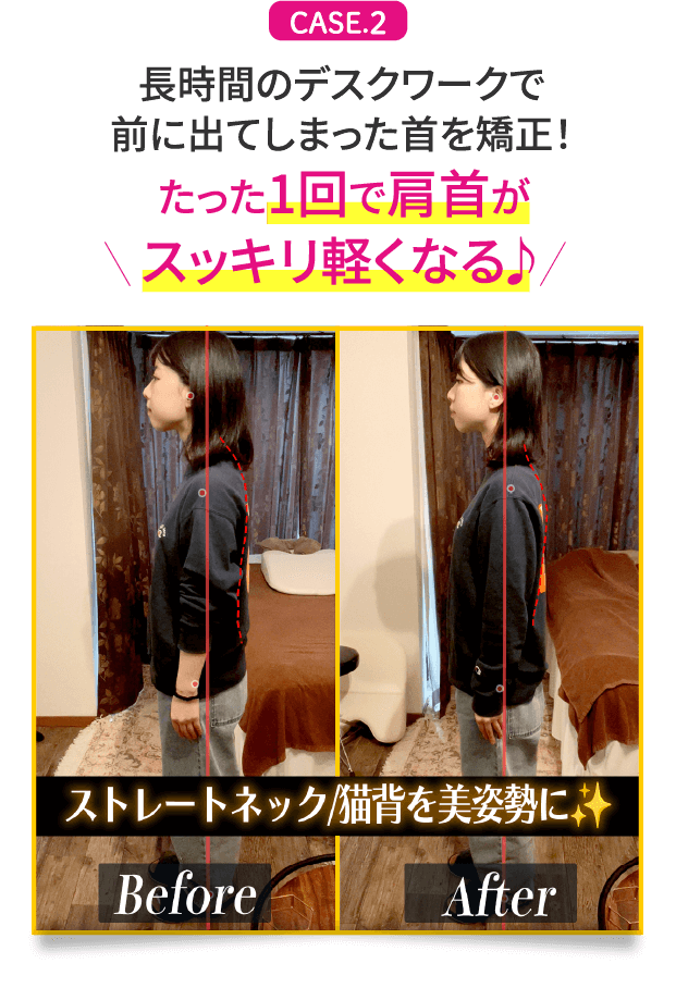 CASE.2 長時間のデスクワークで前に出てしまった首を矯正！たった1回で肩首がスッキリ軽くなる♪