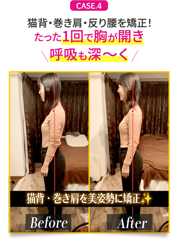 CASE.4 猫背・巻き肩・反り腰を矯正！たった1回で胸が開き呼吸も深〜く